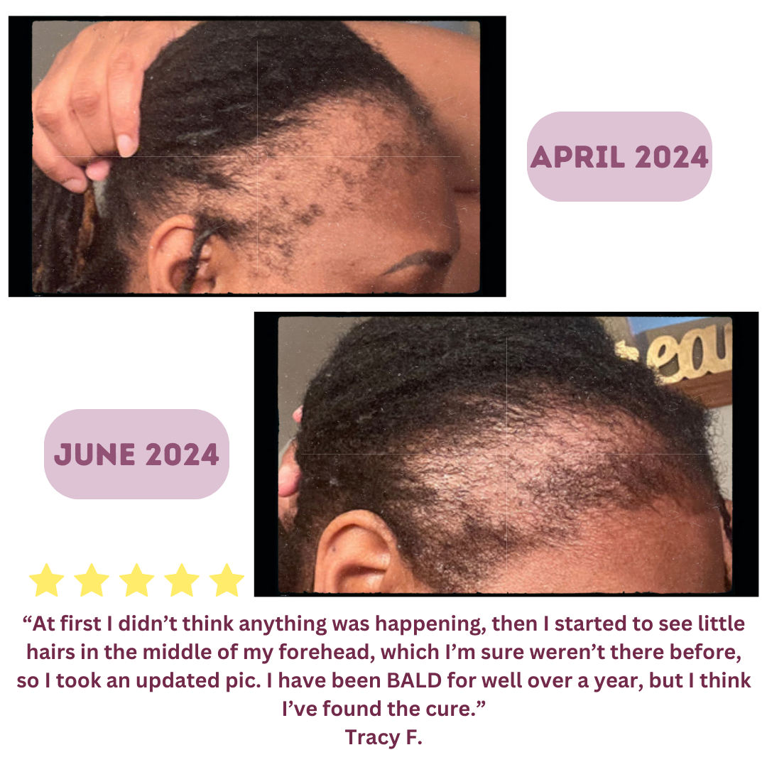 Hair Growth Supplement Bundle - 1 Month Supply - Evoke Apex