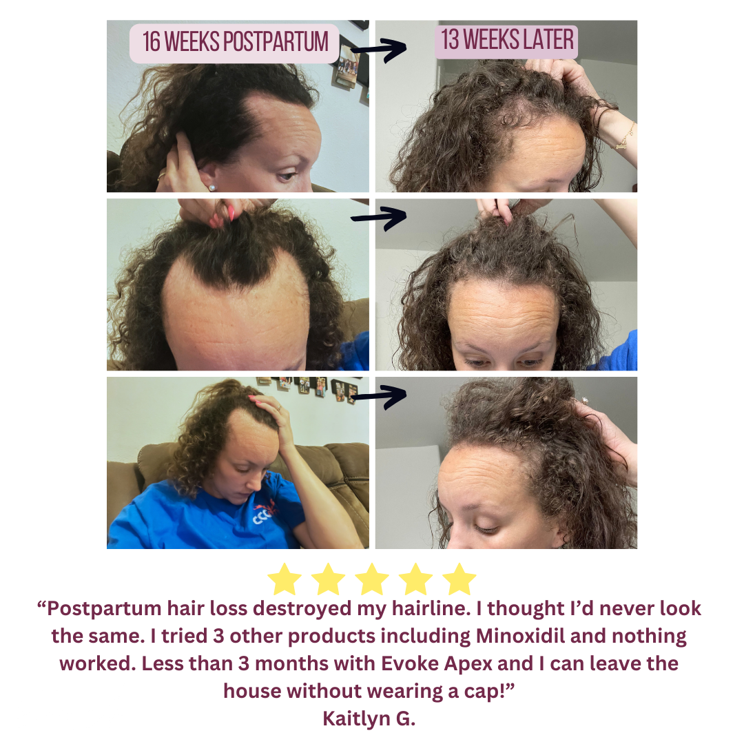 Rosemary Revive Hairline Growth Treatment