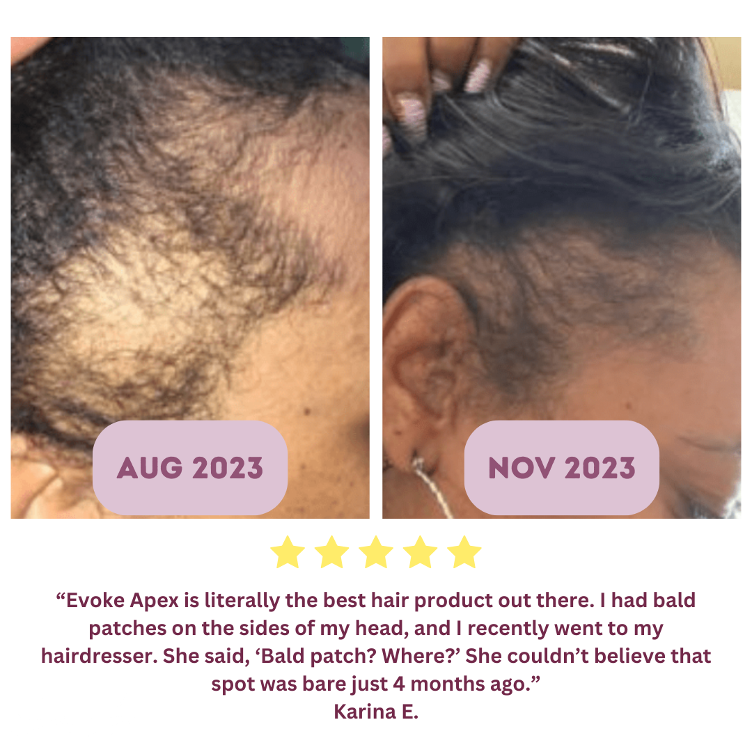Rosemary Revive Hairline Growth Treatment